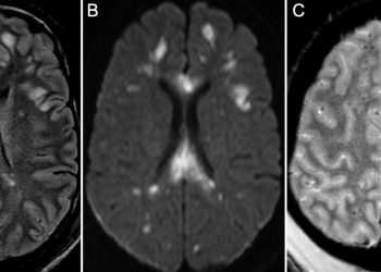 Diffuse axonal injury