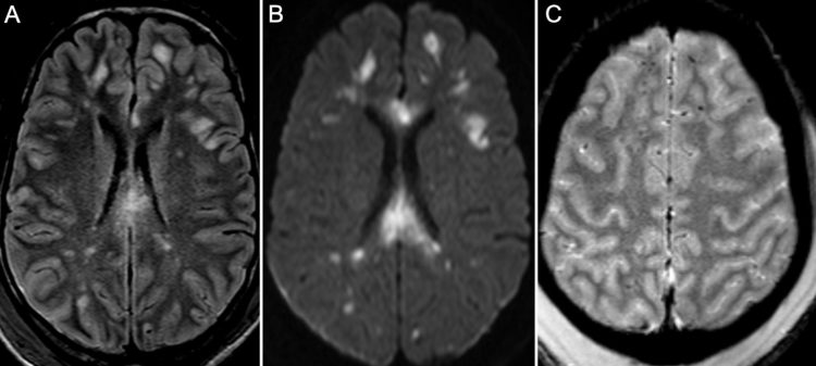 Diffuse axonal injury